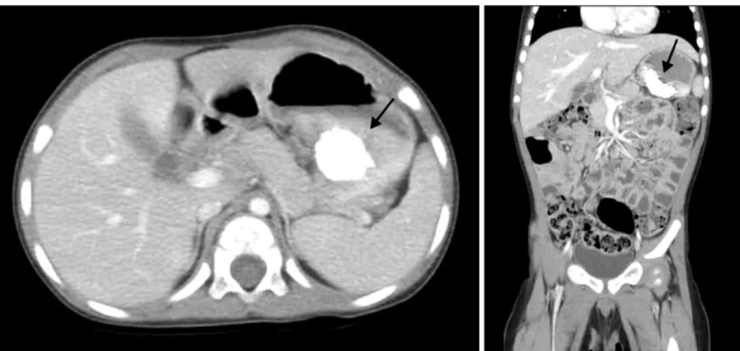Fig.  2.  Abdominal  computed  tomography  (CT)  shows  a  4.5×3.2  cm  sized  soft  tissue  mass  (arrow)  of  the  gastric  wall  with  calcifications.