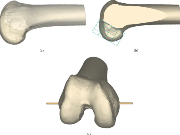 Figure 1: (a) 3D reconstructed model of femur was aligned in a true lateral position, where medial and lateral femoral condyles were superimposed