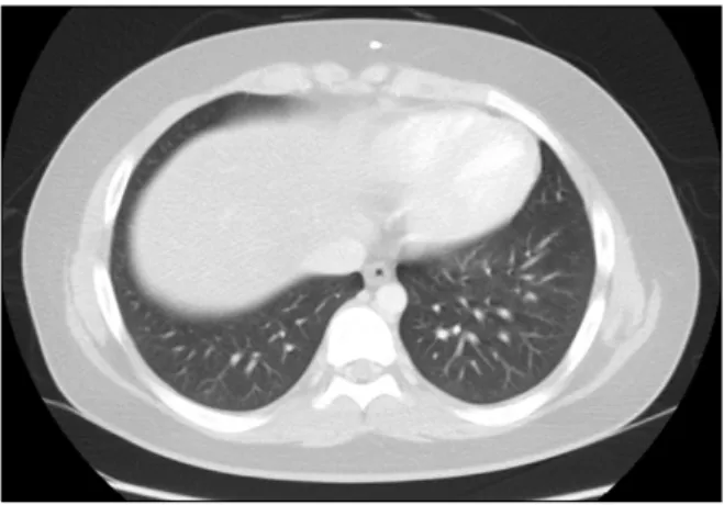 Fig.  3.  Chest  CT  shows  variable  sized  multiple  nodules  in  both  lungs.