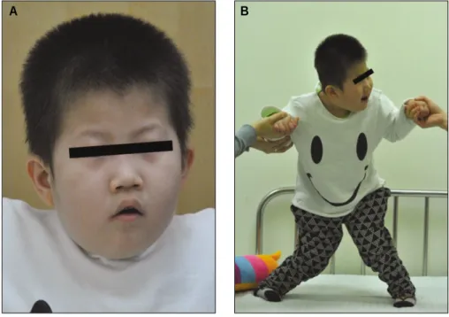 Fig. 1.  Extraoral photo. (A) The patient has specific appearance of PWS such as almond shaped eyes, narrow forehead, thin upper lip, down-warded mouth corner