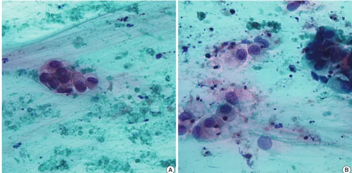 Fig. 1. Cytologic features of mucinous cystadenocarcinoma. (A) A few scattered, variably sized, irregular clusters of columnar cells with pleo- pleo-morphism and anisocytosis in a greenish blue mucinous background and necrotic debris