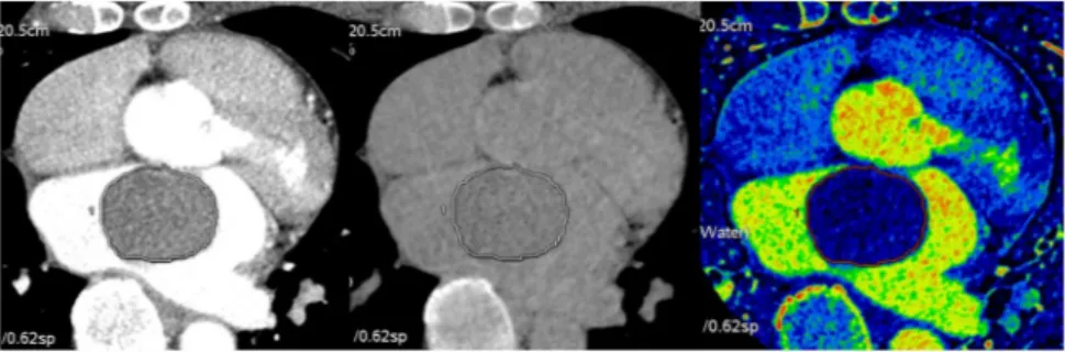 Figure 6.  A representative image set for quantitative analysis of dual-energy CT of a cardiac tumor