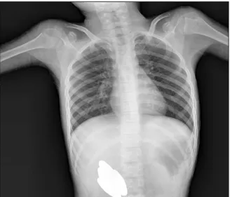 Fig.  1.  Simple  abdominal  radiograph  shows  multiple  radio- radio-paque  foreign  bodies  in  the  right  upper  quadrant.