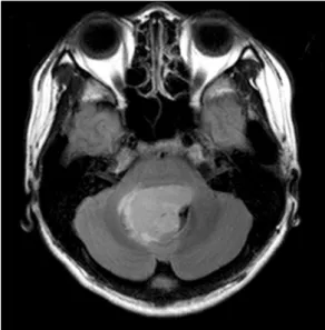 Fig.  1.  Brain  MRI  shows  heterogeneous  enhancing  mass  in  the  4th  ventricle.