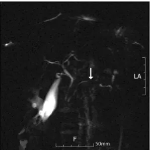 Fig.  1.  Abdominal  CT  finding  on  admission.  The  pancreas  is  diffusely  swollen  without  any  calcification  or  stones.