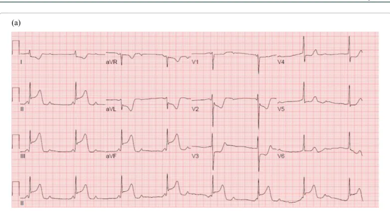 Figure 1: Initial electrocardiography of the patient revealed (a) complete atrioventricular block (CAVB) with marked ST segment elevation in the inferior leads and 