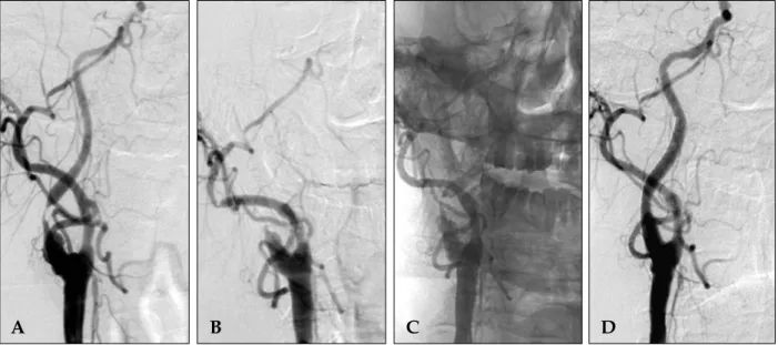 Fig. 2. Serial cerebral angiography. (A) The initial angiography reveals severe stenosis of the right cervical ICA