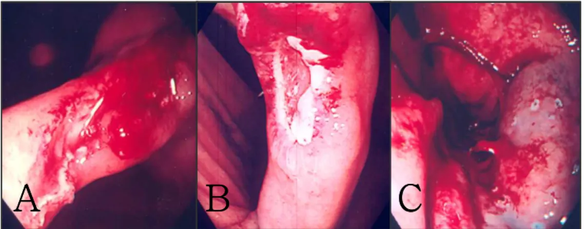 Figure  1.  Degree  of  immediate  PEH.  A,  Endoscopic  view  of  grade  I  PEH;  spontaneous  hemostasis without endoscopic treatment