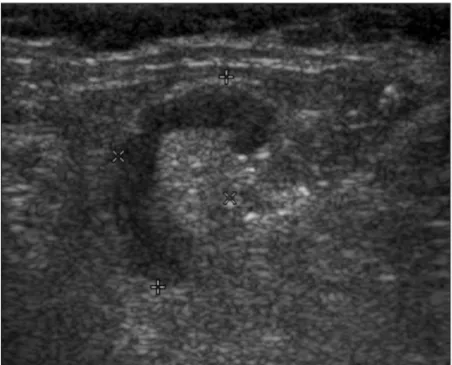 Figure 1. Gray scale sonogram of an axillary lymph node classified as benign in a 28-year-old woman showing a sharp margin, a hypoechoic cortex, a wide hilum, concentric cortical thickening, and an S/L ratio of 0.38
