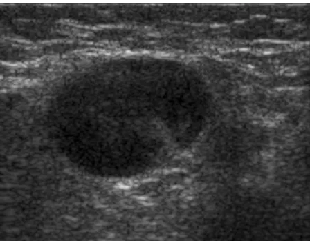 Figure 3. Gray scale sonogram of an axillary lymph node classified as malignant in a 38-year-old man showing a sharp margin, a hypoechoic cortex, a narrow hilum, concentric cortical thickening, and an S/L ratio of 0.73.