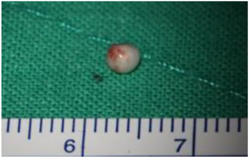 Figure  3.  Gross  photo  of  congenital  cholesteatoma.  The  mass,  congenital  cholesteatoma  is  about  3  mm  and  has  no  damage  by  manual  manipulation  during  surgery