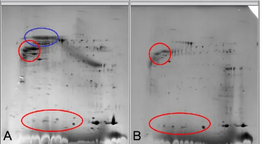 Figure  5.  2D  electrophoresis  with  acquired  (A)  and  congenital  (B)  cholesteatomas