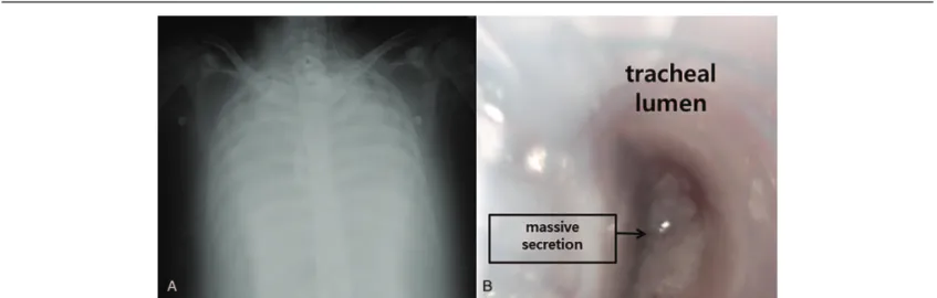 Figure 1. Perioperative images of the patient. A, Preoperative chest x-ray, showing severe diffuse lung consodiation