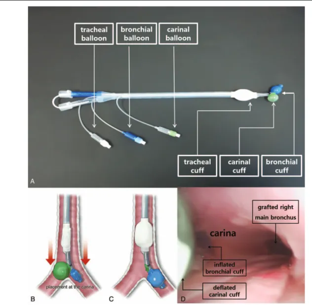 Figure 2. The design of a novel double-lumen endobronchial tube (ANKOR DLT) and its application to the patient