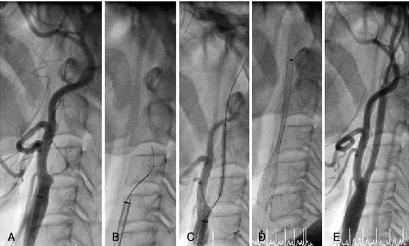Fig. 3. Endovascular treatment. A: proximal ICA occlusion. B: the wire advancing with the microcatheter