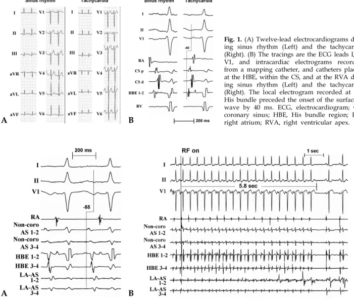 Fig. 1. (A) Twelve-lead electrocardiograms dur- dur-ing sinus rhythm (Left) and the tachycardia (Right)