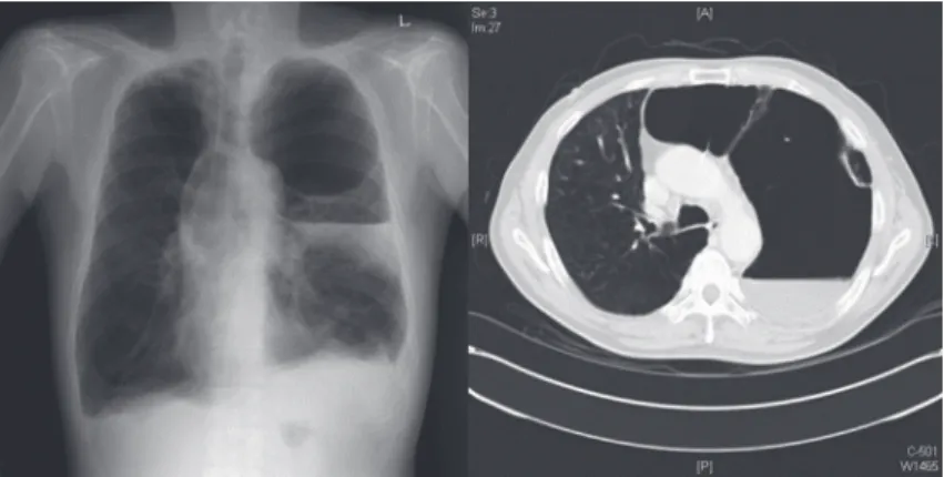 Figure 1. A chest radiography and computed tomography showed newly developed pleural 