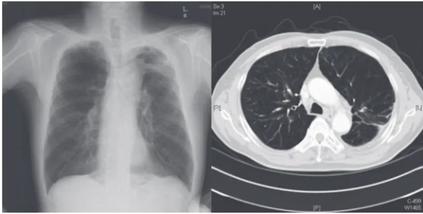 Figure  2.  Follow  up  radiography  and  computed  tomography  revealed  disappearance  of 