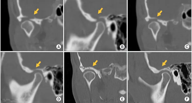 Fig. 2. Case 1. Coronal and sagittal images of computed tomography (CT). A, B. Preoperative CT image (A: coronal, B: sagittal)