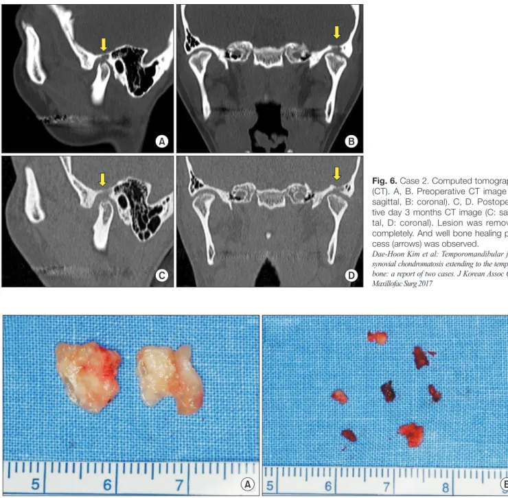 Fig. 7. Case 2. A. Soft mass in joint space. B. Grayish mass in intrabony lesion. 