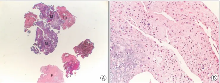 Fig. 8. Case 2. Histopathologic examination of the specimen. A. Histopathologic examination of the specimen reveals cellular masses (M)  and areas of fibrous tissue (F) (H&amp;E staining, ×10)