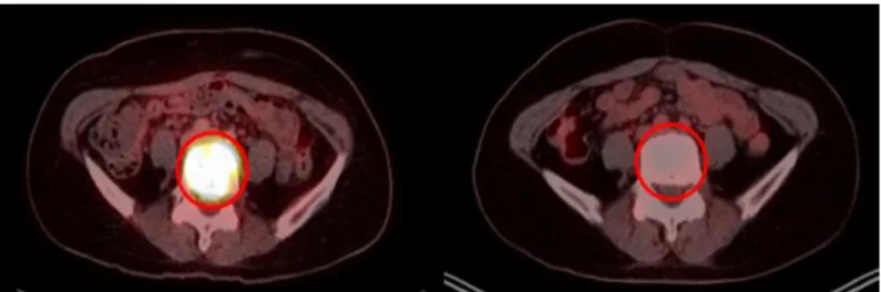 Fig 4. Use of FDG PET/CT to assess treatment response. (a) Complete response after RT with 94.4% reduction (39.79 to 2.23) in maximum standardized uptake