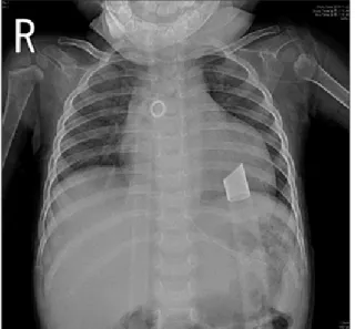 Fig. 1.  Initial chest radiography demonstrated marked cardiomeg-