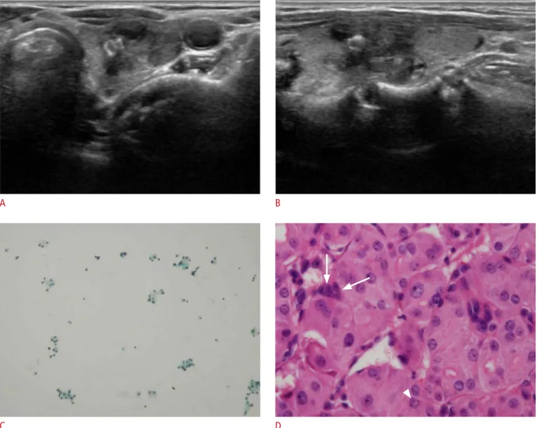 Fig. 2.  An incidentally detected thyroid mass in a 62-year-old woman. 