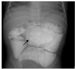 Fig  3.  Twin  one.  Small  bowel  series  at  the  age  of  39-month-old  shows  markedly  dilated  ileum  (arrow).