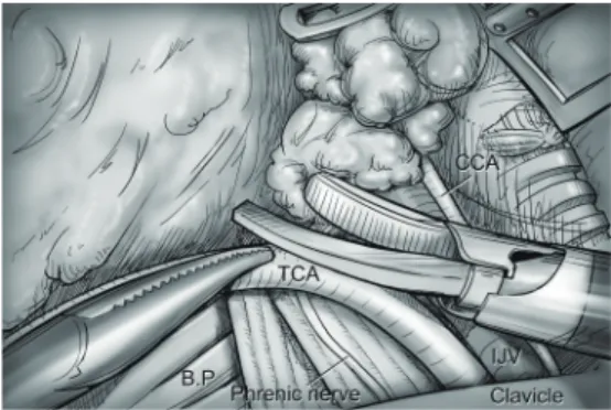 Figure 10 Level V dissection. After clearing level IV area, the 