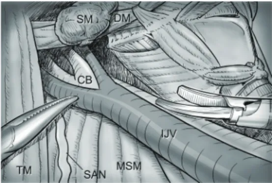 Figure 12 Level II dissection. The level IIA dissection proceeds 