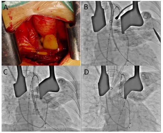 Fig. 3. Transcatheter aortic valve implantation by transaortic approach. (A) Exposure of ascending aorta by mini-sternotomy, (B) Insertion of a 18F sheath into ascending aorta, (C) Partial deployment of self-expanding CoreValve within aortic valve, (D)  Co