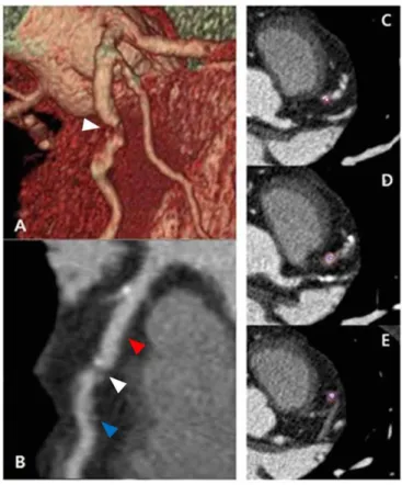 Figure  1.  Coronary  plaques  in  the  mid-left  anterior  descending  artery 