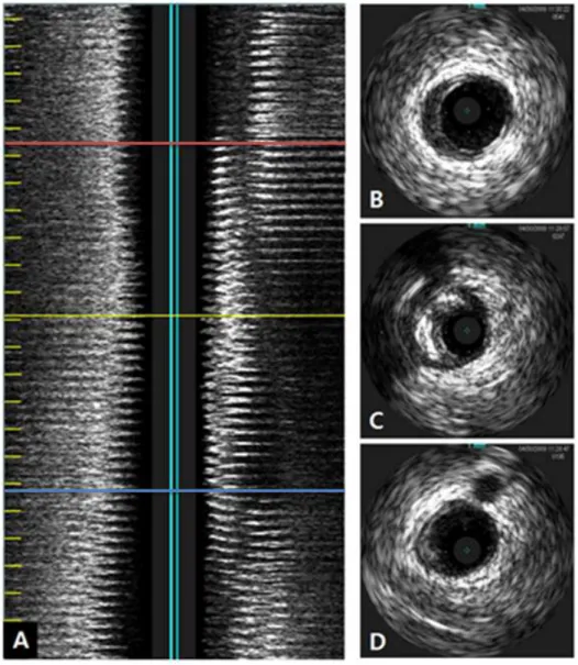 Figure  2.  Intravascular  ultrasound  longitudinal  image  (A).  Yellow 