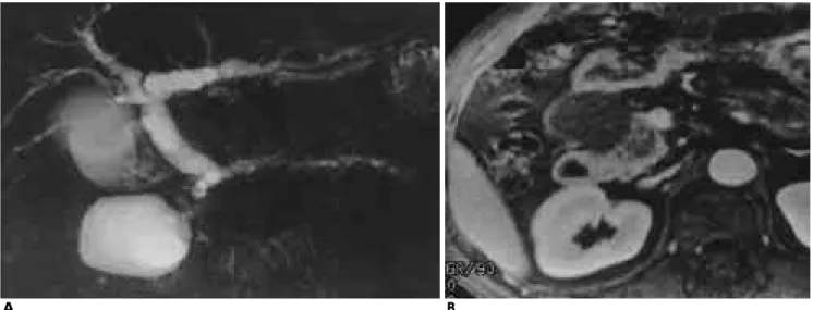 Fig. 1. Pancreas cancer with pseudocyst 