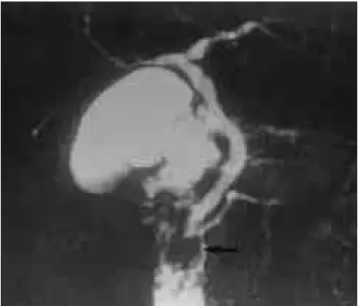 Fig. 2. Ampullary tumor.