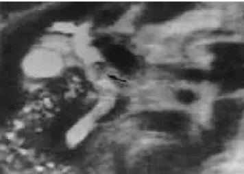 Fig. 4. False positive of choledocholithiasis. A sharply demar-