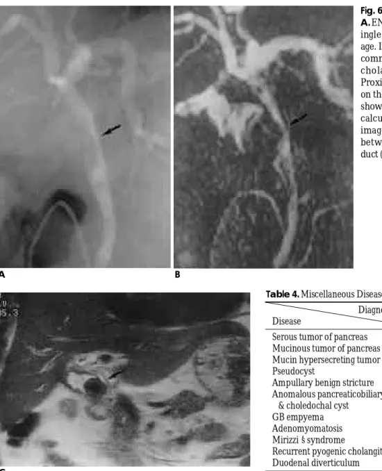 Fig. 6. Mirizzi syndrome