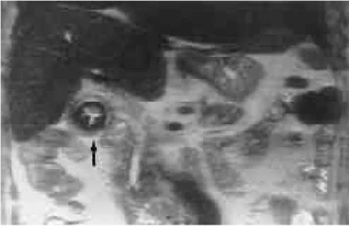 Fig. 8. Gallstone-Mercedez Benz sign.