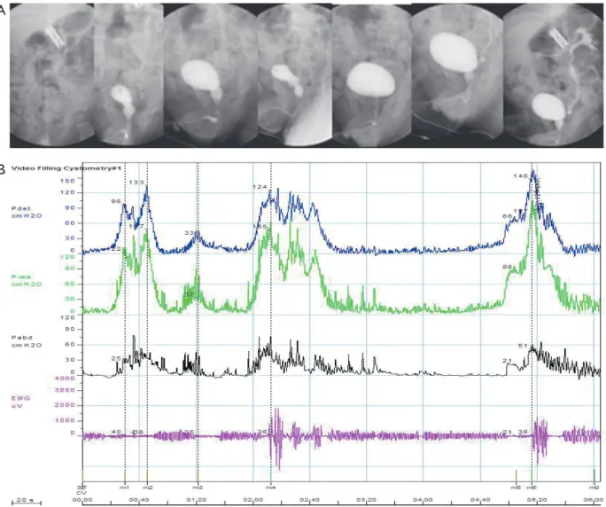 Figure 1 Video-urodynamic study of a 2 month-old boy. A. Asymmetrical bladder contraction is seen along with left GIII 