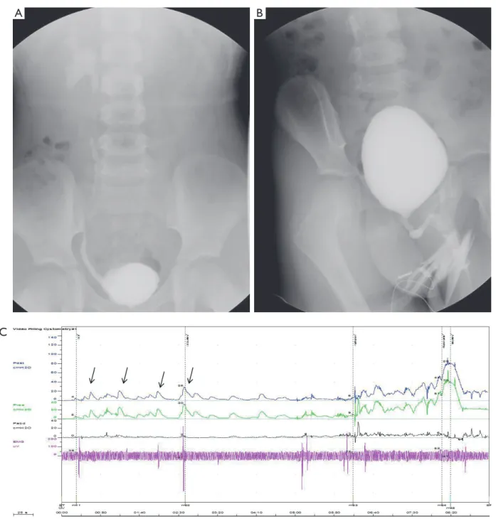 Figure 2 Video-urodynamic study of a 5 year-old male with history of urinary tract infection