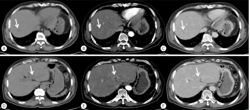 Fig. 1.  Computer tomography showed multiple small (≤1.6 cm) low density lesions with peripheral enhancement in liver (white arrow)