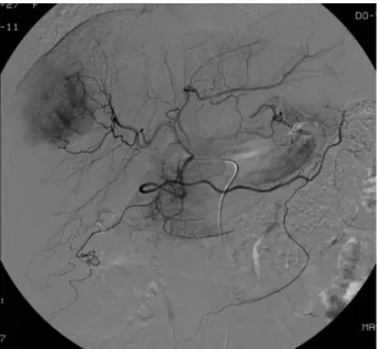 Fig. 2. Hepatic artery angiogram. A single hypervascular  mass was noted in the S7. There were no definite daughter  nodules.치료로는 절제술이 우선이며 5년 생존율은 50% 이상 된다