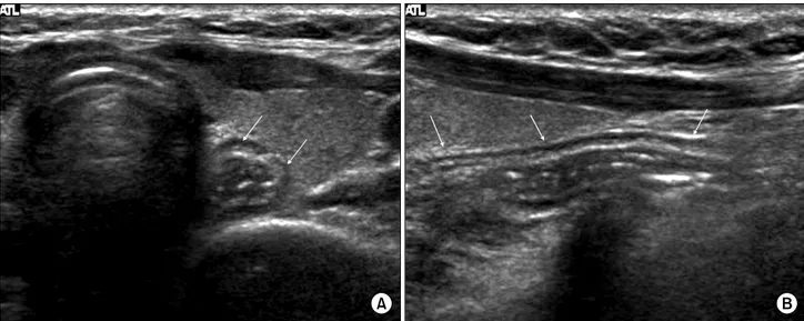 Fig.  2.  Normal  esophagus  in  posterior  aspect  of  left  thyroid  gland.  Transverse  US  image  (A)  shows  target  appearance  mass  like  lesion 