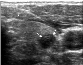 Fig.  5.  Mixed  echoic  nodule.  US  shows  mass  containing  both  cyst-
