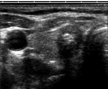 Fig.  8.  Microcalcification  in  thyroid  mass.  US  shows  numerous  mi-