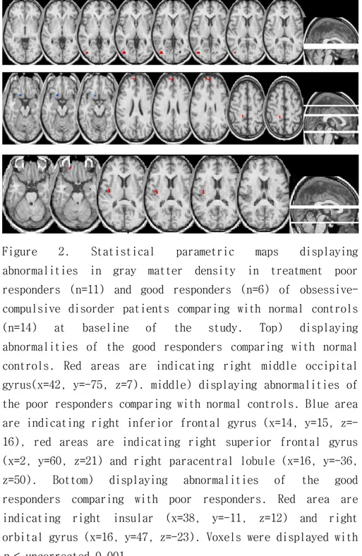 Figure  2.  Statistical  parametric  maps  displaying  abnormalities  in  gray  matter  density  in  treatment  poor  responders  (n=11)  and  good  responders  (n=6)  of   obsessive-compulsive  disorder  patients  comparing  with  normal  controls  (n=14)