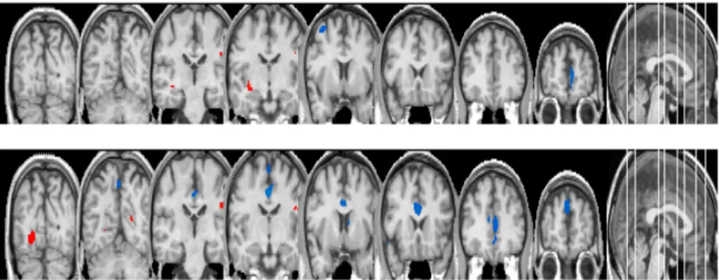 Figure  5.  Statistical  parametric  maps  displaying  changes  in  gray matter concentration in two OCD patient groups comparing  with  normal  controls  after  2  year  treatment
