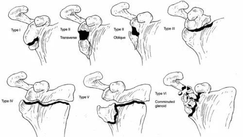Fig. 1. Modified Ideberg classification of glenoid fractures is categorized into six types, including comminuted type VI.