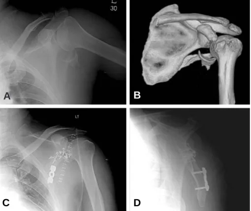 Fig. 2. (A, B) Initial X-ray and 3D CT scan of 54-year-old male show glenoid fracture (modified Ideberg type II) and